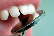 Разработана вакцина от кариеса