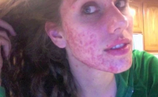 Девушка с акне стала моделью на Нью-Йоркской неделе моды