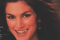 Брекеты: самочувствие пациентов после снятия и дальнейший уход за зубами