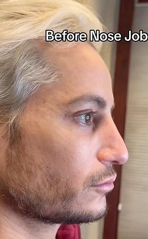 41-летний Фрэнки опубликовал в соц.сетях фотографии до и после ринопластики; Это фото "до операции"