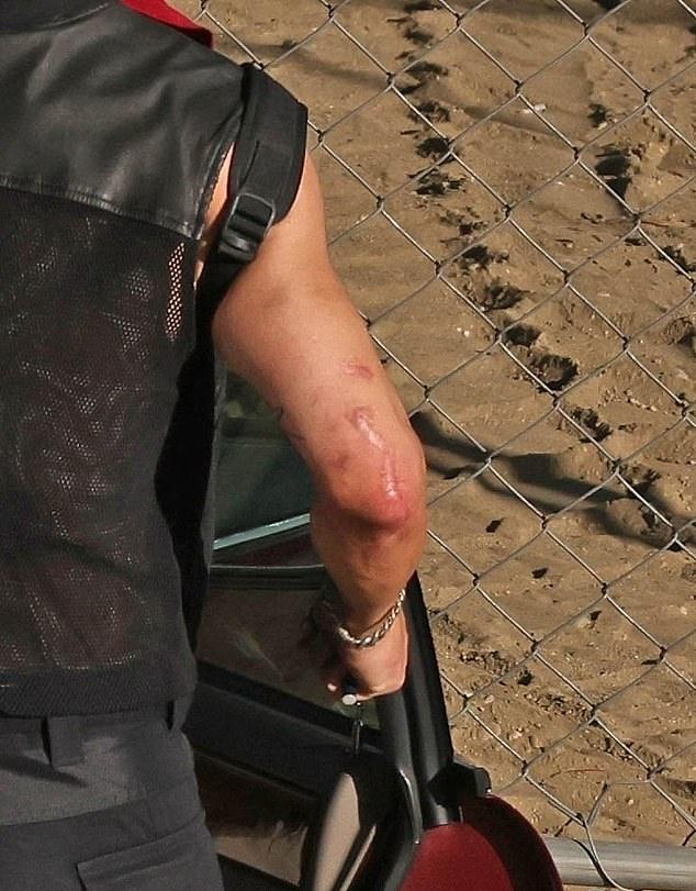 В кожаном и сетчатом жилете был виден шрам от перенесенной инфекции плотоядных бактерий в 2022 году.