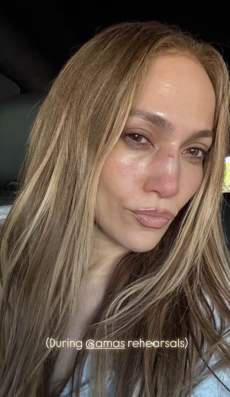 Дженнифер Лопес выложила во вторник в Instagram фото своей травмы лица, полученной на репетициях AMAs.