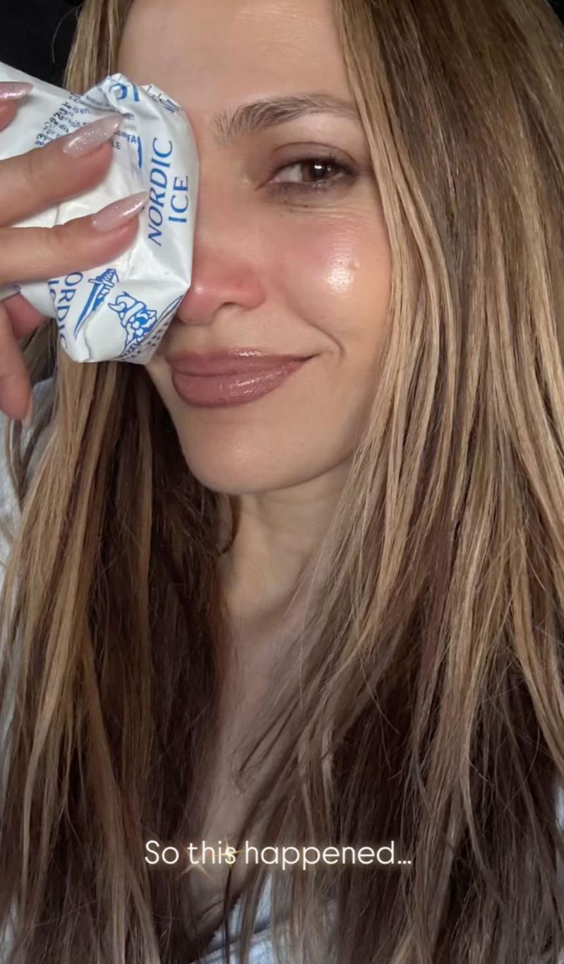 Дженнифер Лопес показала в Instagram во вторник травму лица после репетиций AMAs.