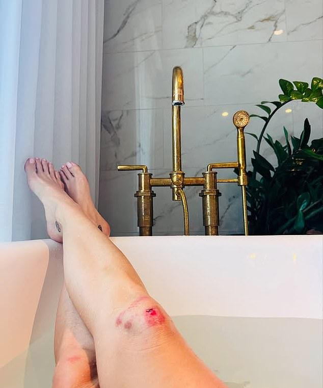 40-летняя поп-мегазвезда выложила в Instagram галерею фото, включая снимок своего окровавленного колена.