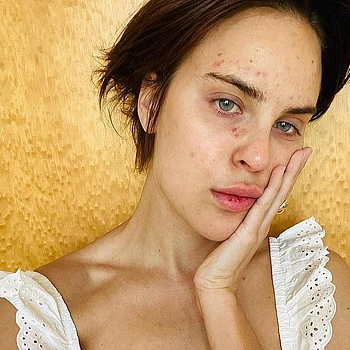 Дочь Деми Мур и Брюса Уиллиса Таллула раскрыла последствия своего расстройства, выражающегося в расцарапывании кожи