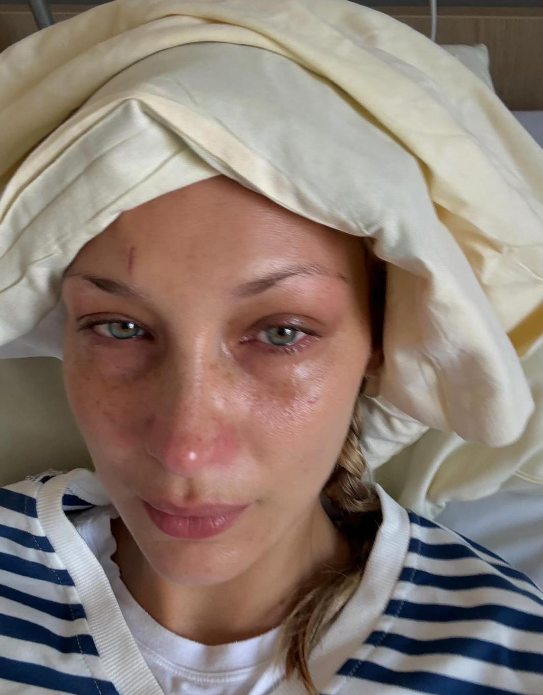 Белла Хадид на больничной койке, с опухшим лицом и глазами, в полосатой рубашке.
