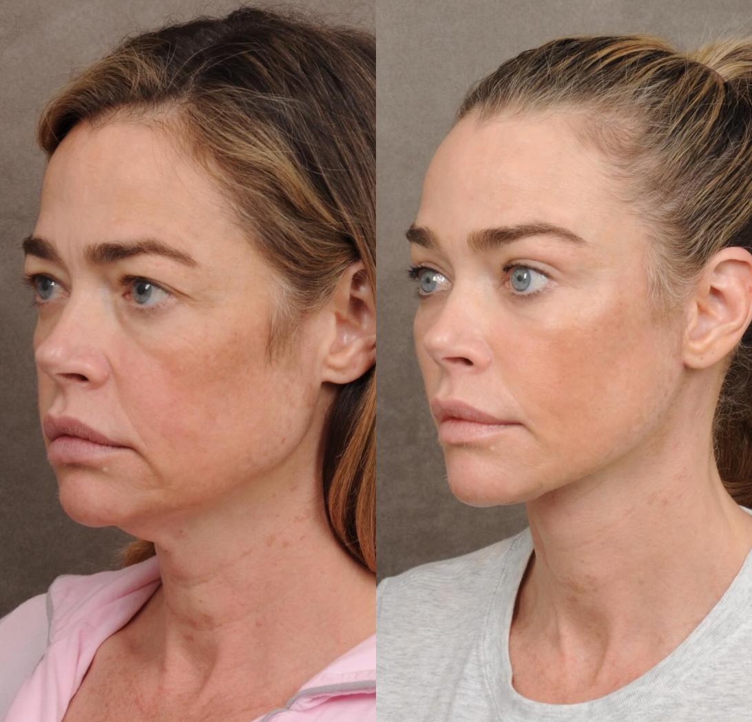 Дениз Ричардс выглядит «сногсшибательно» после шокирующего преображения в результате подтяжки лица