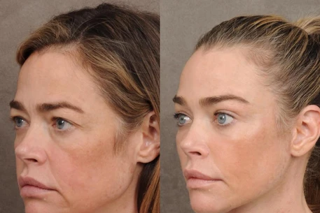 Дениз Ричардс выглядит «сногсшибательно» после шокирующего преображения в результате подтяжки лица