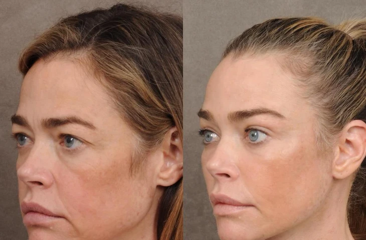 Дениз Ричардс выглядит «сногсшибательно» после шокирующего преображения в результате подтяжки лица