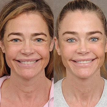 Пластический хирург Дениз Ричардс показал потрясающие фото актрисы до и после подтяжки лица