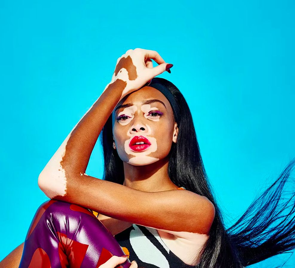 Идеальная кожа — миф: голливудские звёзды, которые живут с хроническими кожными заболеваниями